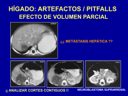 Figura 8. Artefactos / Pitfalls relacionados con el hígado.
