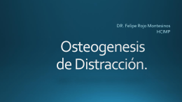 Osteogenesis de Distracción.