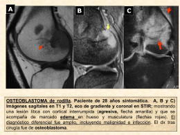Figura 23: NO DIAGNÓSTICO ESPECÍFICO: osteoblastoma fémur