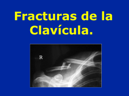 02-Clavicula fractura lux ac cl - lerat