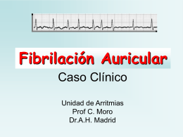 Fibrilación Auricular Paroxística - Cardiología en Madrid