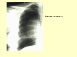 Contusión pulmonar derecha hemitórax derecho