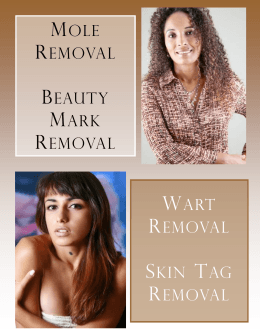 MOLE REMOVAL BEAUTY MARK REMOVAL WART REMOVAL