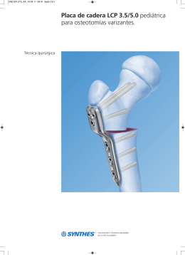 Placa de cadera LCP 3.5/5.0 pediátrica para osteotomías varizantes.