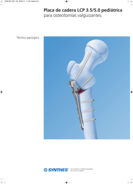 Placa de cadera LCP 3.5/5.0 pediátrica para osteotomías