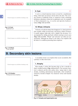B. Secondary skin lesions