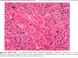 Placental site trophoblastic tumor