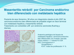 Mesenteritis retráctil por Carcinoma endócrino bien diferenciado