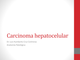 Hepatocarcinoma Carcinoma hepatocelular