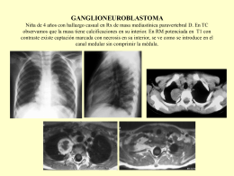 2._ganglioneuroblastoma