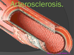 Arterosclerosis.