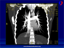 Angiotomografía helicoidal con sustracción de