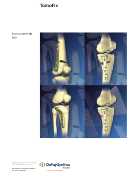 TomoFix - DePuy Synthes