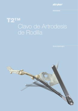 T2™ Clavo de Artrodesis de Rodilla