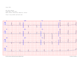 I II III II aVR aVL aVF V1 V2 V3 V4 V5 V6 - ECG Wave