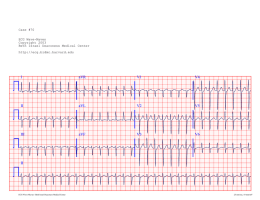 Chart Recording - ECG Wave