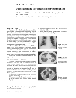 Opacidades nodulares y alveolares múltiples en varón no fumador